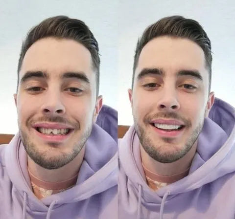 Custom Fit Smile Veneers Upper Lower Teeth Covers