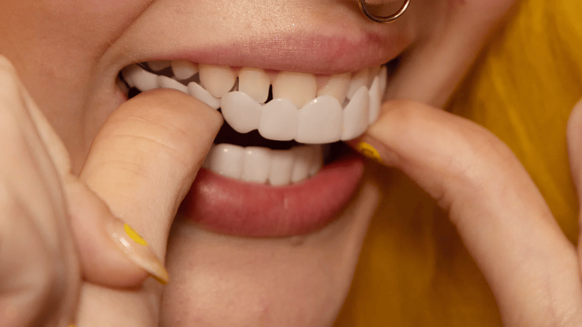 Custom Fit Snap On Cosmetic Teeth Veneers