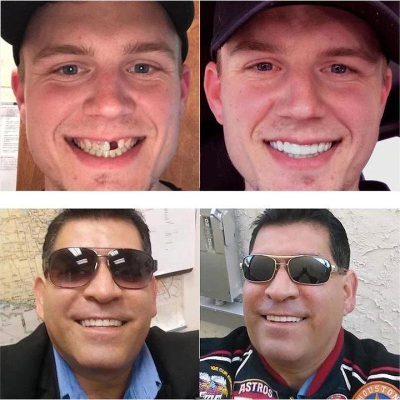 Custom Fit Snap On Smile Teeth Veneers