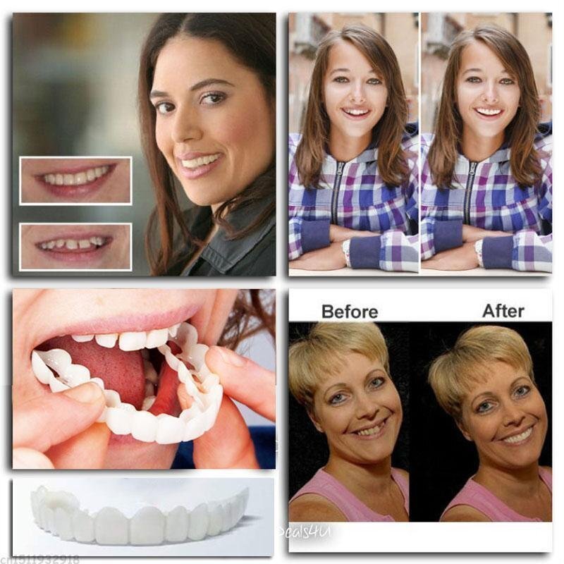 Custom Fit Snap On Smile Teeth Veneers