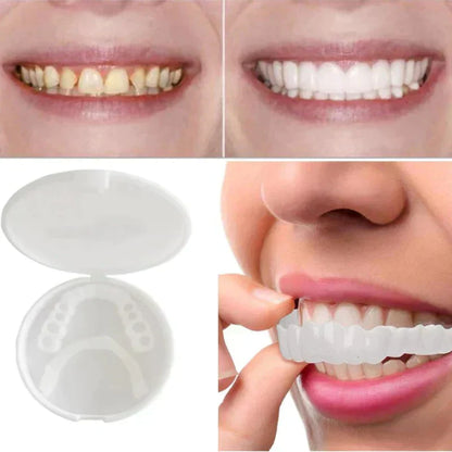 Temporary Snap On Dental Veneer for Cosmetic Smile Enhancement